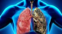 Sigara ve Akciğer kanseri